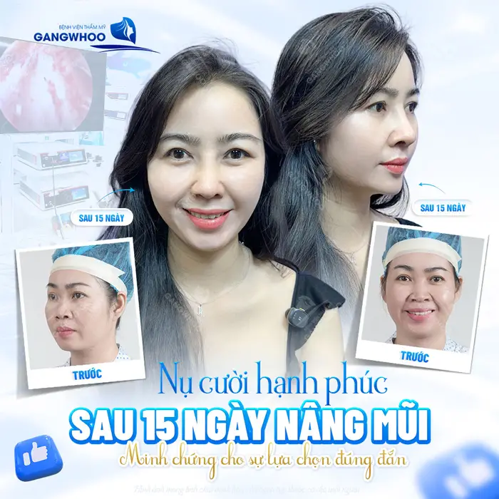 Nụ cười hạnh phúc sau 15 ngày nâng mũi minh chứng cho lựa chọn đúng đắn khi thực hiện tại BVTM Gangwhoo