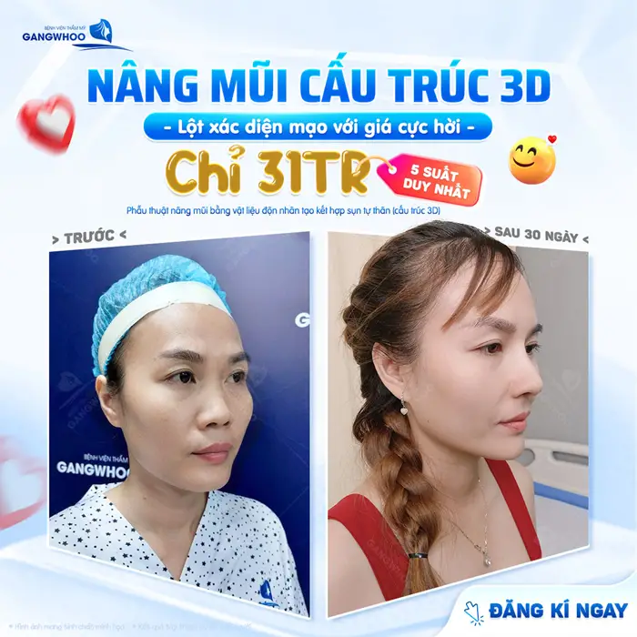 Nâng mũi cấu trúc 3D lột xác diện mạo với giá cực hời vẫn yên tâm sở hữu mũi đẹp dài lâu