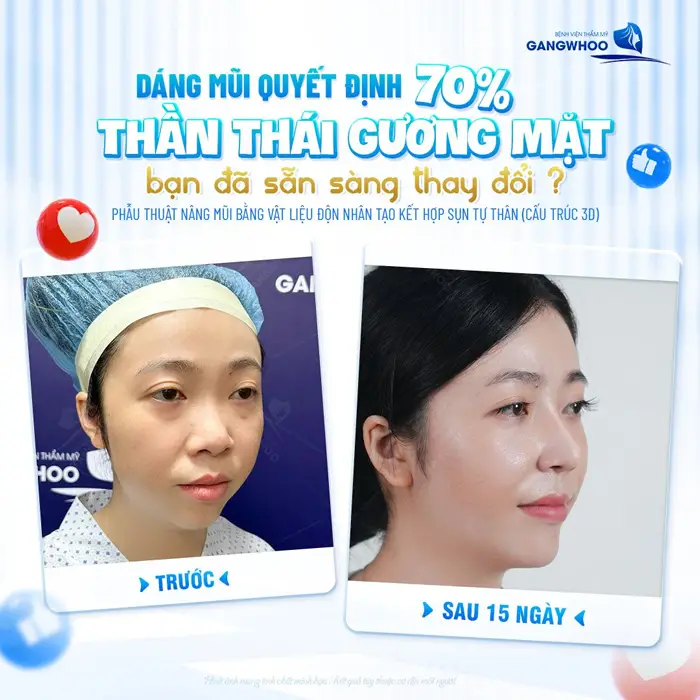 Nâng Mũi Bọc Sụn Có Vĩnh Viễn Không? Cách Duy Trì Lâu Dài 5 Nâng mũi nâng thần thái giải pháp hoàn hảo cho gương mặt thêm bừng sáng và tự tin