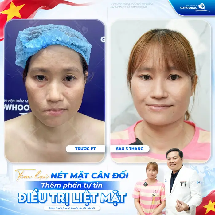 Liệt Dây Thần Kinh Số 7 Nguy Hiểm Không? Triệu Chứng Và Điều Trị 17 Tìm lại nét mặt cân đối gương mặt thêm tự tin sau 3 tháng sự cải thiện đã rõ rệt