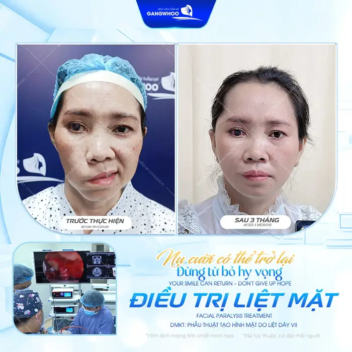 Nụ cười có thể trở lại sau phẫu thuật điều trị liệt mặt kết quả chỉ sau 3 tháng đã hoàn toàn khác biệt