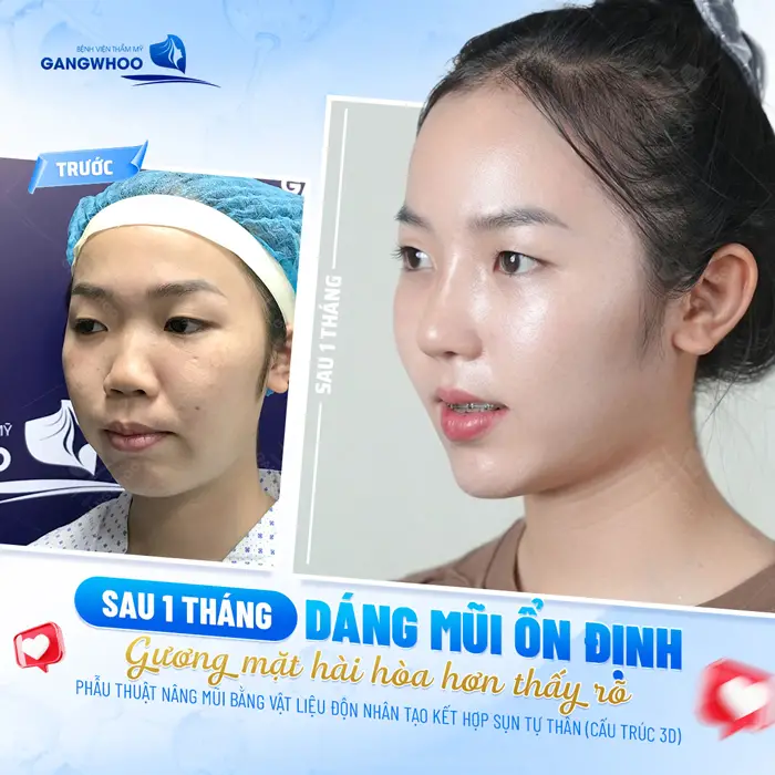 Nâng Mũi Bọc Sụn Có Vĩnh Viễn Không? Cách Duy Trì Lâu Dài 1 Sau 1 tháng dáng mũi ổn định gương mặt hàihòa hơn thấy rõ