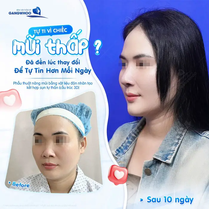 Gạt bỏ tự ti vì mũi thấp đã đến lúc tự tin hơn mỗi ngày với dáng mũi cao đẹp và hài hòa với khuôn mặt