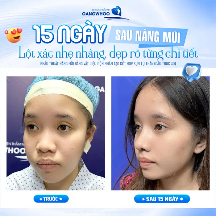 15 ngày sau nâng mũi lột xác nhẹ nhàng nhưng đẹp rõ từng chi tiết sự khác biệt sau 15 ngày thực hiện 