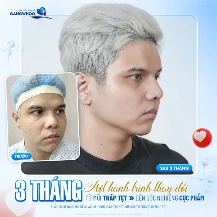 3 tháng 1 hành trình thay đổi từ mũi thấp tẹt đến góc nghiêng cực phẩm
