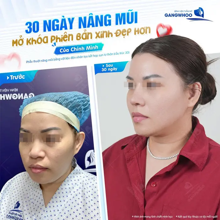 30 ngày nâng mũi mở khóa phiên bản xinh đẹp và rạng rỡ của chính mình