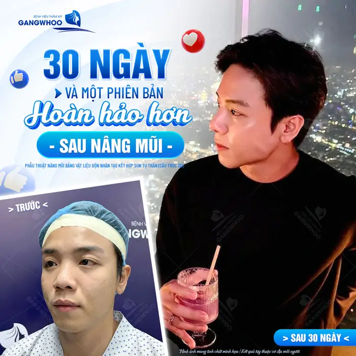 30 ngày và 1 phiên bản hoàn toàn khác sau nâng mũi một sự thay đổi đáng ngưỡng mộ của chàng trai trẻ dám thay đổi