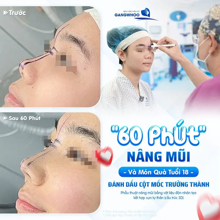 60 phút nâng mũi và món quà tuổi 18 đánh dấu cột mốc trưởng thành với sự thay đổi đầy đáng giá