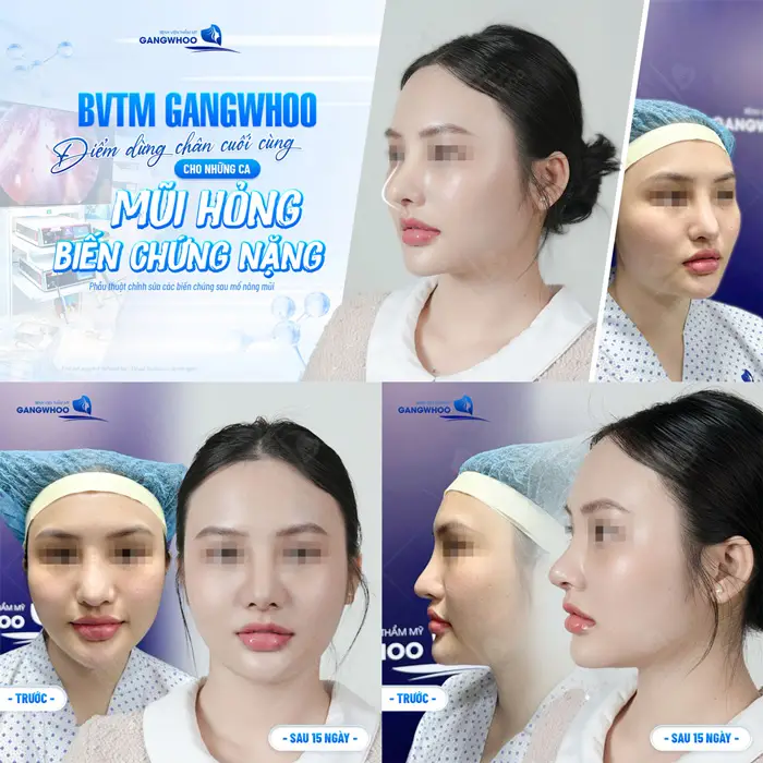 BVTM Gangwhoo điểm đến cuối cùng cho những ca mũi hỏng có biến chứng nặng