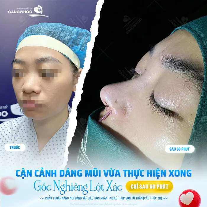 Cận cảnh dáng mũi vừa thực hiện xong góc nghiêng đã lột xác hoàn hảo chỉ sau 60 phút thực hiện 