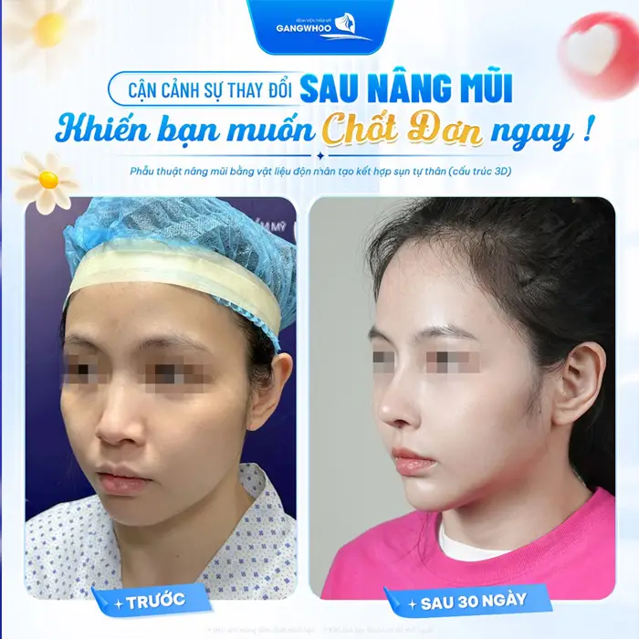 Nâng Mũi Hàn Quốc Ở Đâu Đẹp Tại TPHCM? 10 Địa Chỉ Uy Tín 6 Cận cảnh sự thay đổi sau nâng mũi nhan sắc thêm thăng hạng diện mạo thêm phần cuốn hút