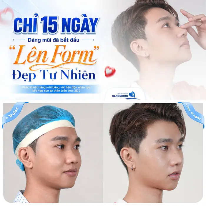 Chỉ 15 ngày dáng mũi đã lên form đẹp tự nhiên diện mạo theo đó cũng đẹp bừng sức sống và thăng hạng hơn thấy rõ