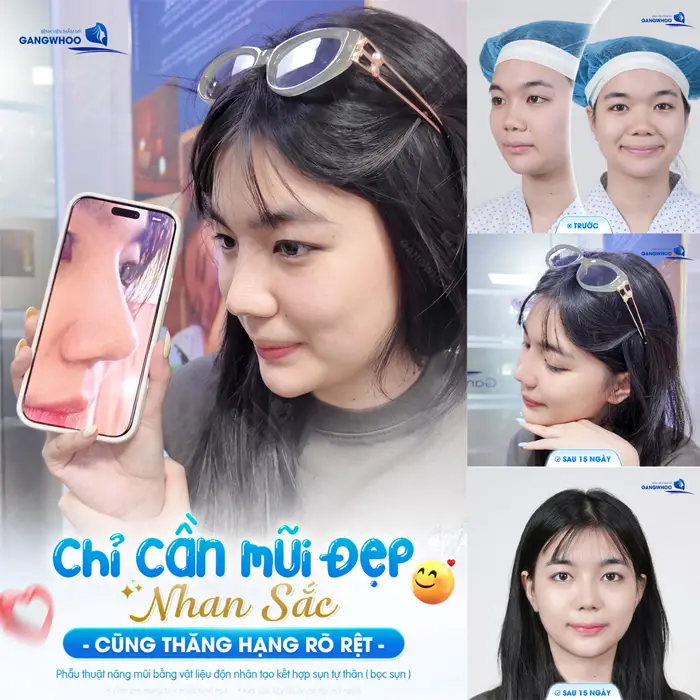 Nâng Mũi Hàn Quốc Ở Đâu Đẹp Tại TPHCM? 10 Địa Chỉ Uy Tín 1 Chỉ cần mũi đẹp nhan sắc cũng thăng hạng hơn thấy rõ