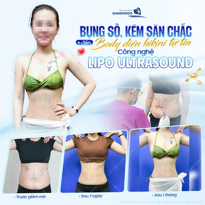 Tự tin diện bikini tự tin khoe eo thon nuột nà sau 1 tháng phẫu thuật (Lipo Ultrasound)
