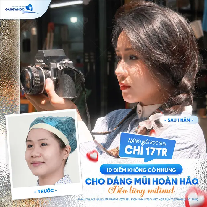 Nâng mũi đẹp 10 điểm không có nhung cho dáng mũi cao đẹp hoàn hảo 