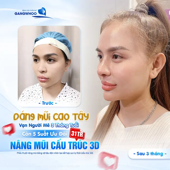 Dáng mũi cao vạn người si mê sau 3 tháng tuổi đẹp đến xiêu lòng