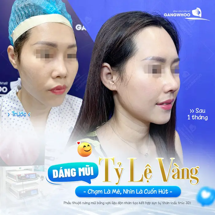 Dáng mũi đẹp chuẩn tỷ lệ vàng chạm là mê, nhìn là cuốn sau 1 tháng diện mạo đã đẹp và mềm mại hơn