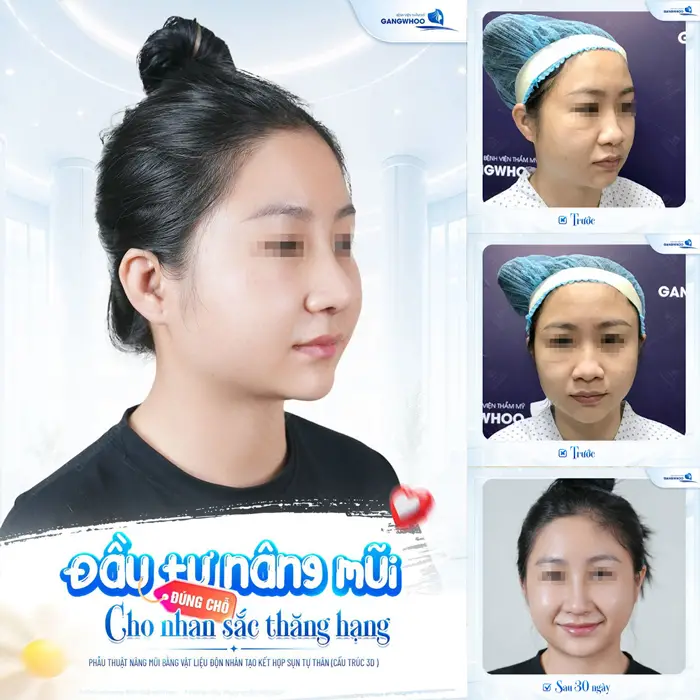 Nâng Mũi Bọc Sụn Hàn Quốc - Bí Quyết Dáng Mũi Cao Thanh Tú 2 Đầu tư nâng mũi cho nhan sắc thăng hạng sau 30 ngày can thiệp nhan sắc đã thăng hạng đầy rạng rỡ