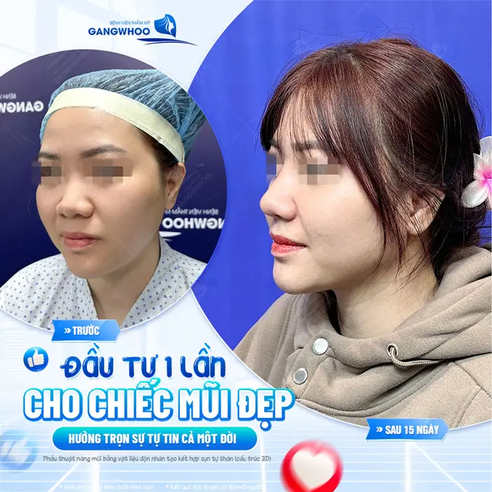 Đầu tư 1 lần cho chiếc mũi đẹp hưởng trọn sự tự tin cả 1 đời 