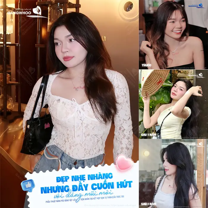 Một thay đổi nhẹ nhàng nhưng xinh đẹp đầy cuốn hút với dáng mũi mới sau phẫu thuật 