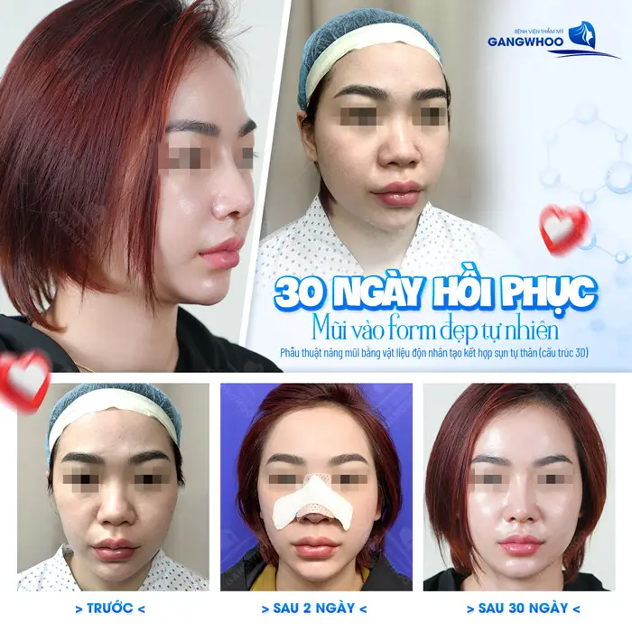 5+ Địa Chỉ Nâng Mũi Uy Tín Tại TPHCM