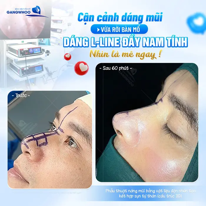 5+ Địa Chỉ Nâng Mũi Uy Tín Tại TPHCM