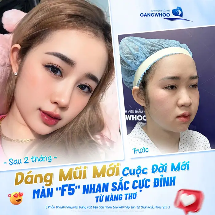 5+ Địa Chỉ Nâng Mũi Uy Tín Tại TPHCM