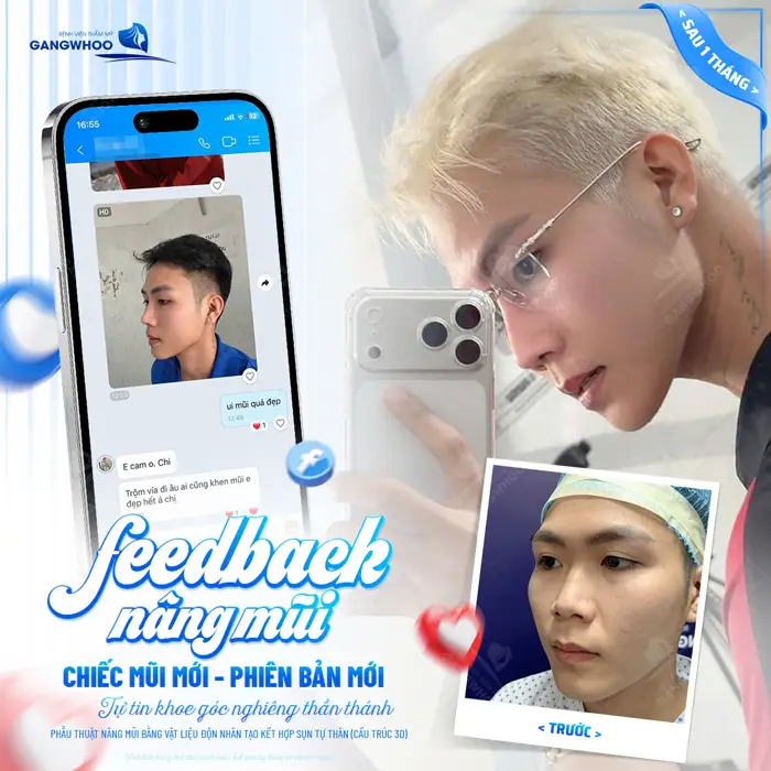 5+ Địa Chỉ Nâng Mũi Uy Tín Tại TPHCM