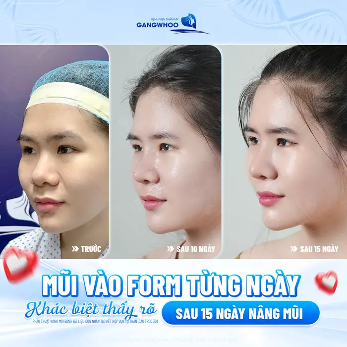 5+ Địa Chỉ Nâng Mũi Uy Tín Tại TPHCM