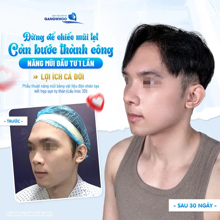 Đừng để chiếc mũi tẹt cản bước thành công nâng mũi đầu tư 1 lần lợi ích được cả đời