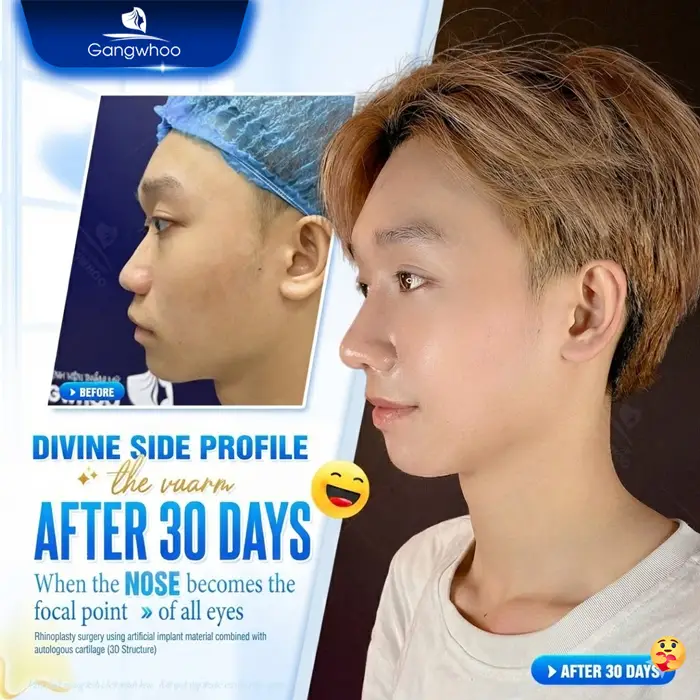 en nang mui khi nang mui khong phau thuat 1