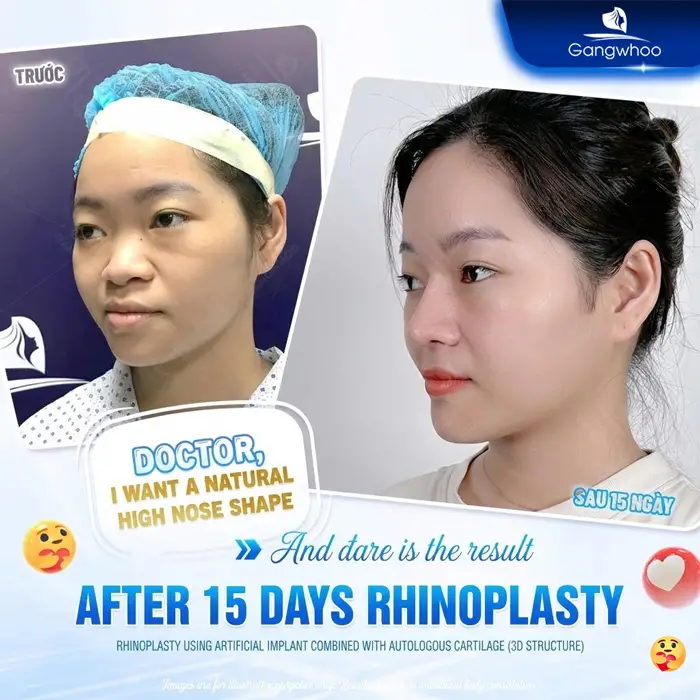 en nang mui khi nang mui khong phau thuat 2