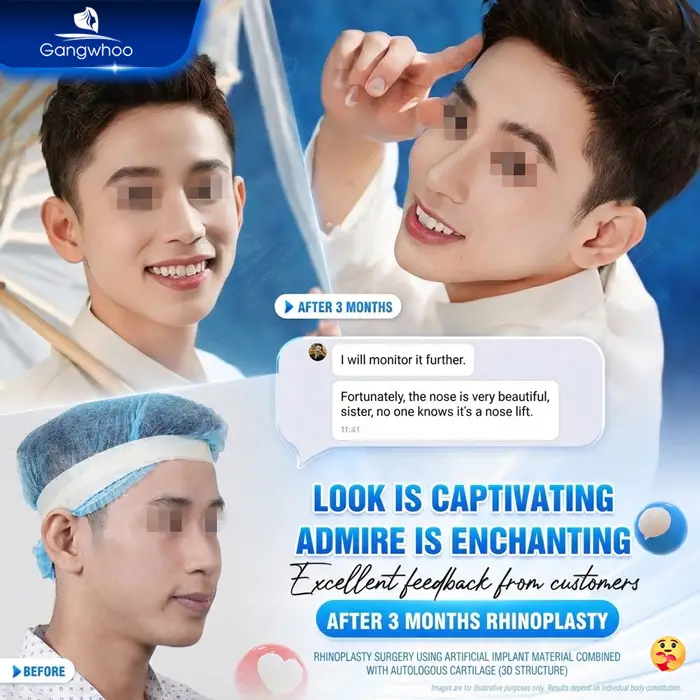 en nang mui khi nang mui khong phau thuat 3