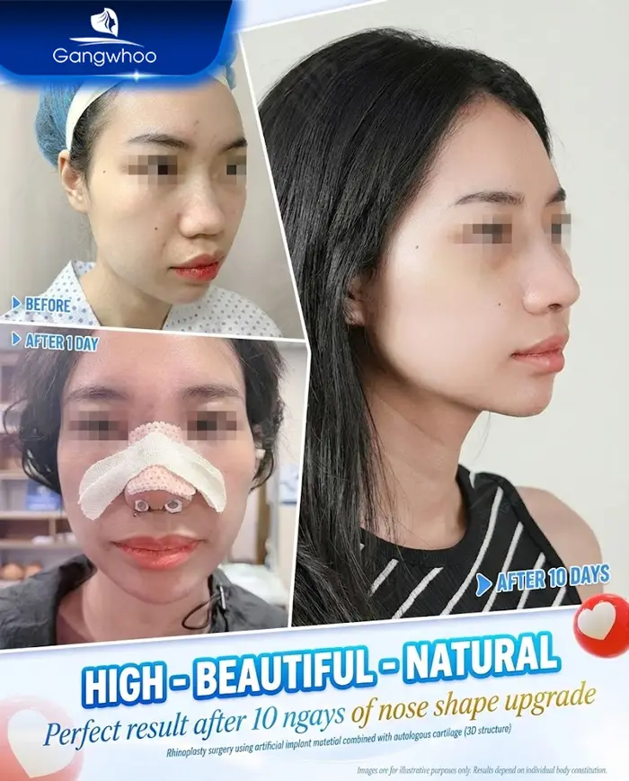 en nang mui khi nang mui khong phau thuat 4