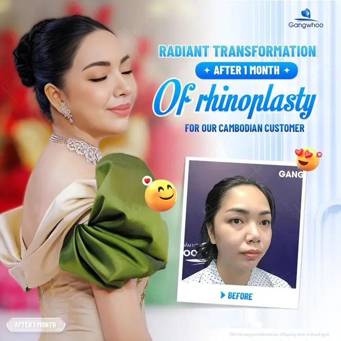 en nang mui khi nang mui khong phau thuat 5