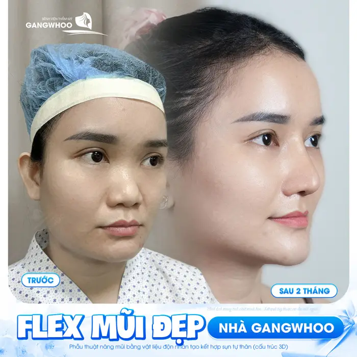 flex mui dep nha gangwhoo 3