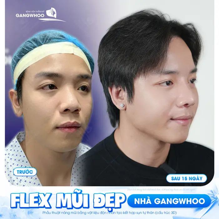 flex mui dep nha gangwhoo 4