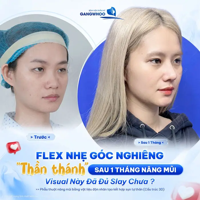 Nâng Mũi Bán Cấu Trúc Là Gì? Ưu Điểm Và Chi Phí 5 Flex góc nghiêng thần thánh sau 1 tháng nâng mũi "visual" thăng hạng đẹp chuẩn thần thái
