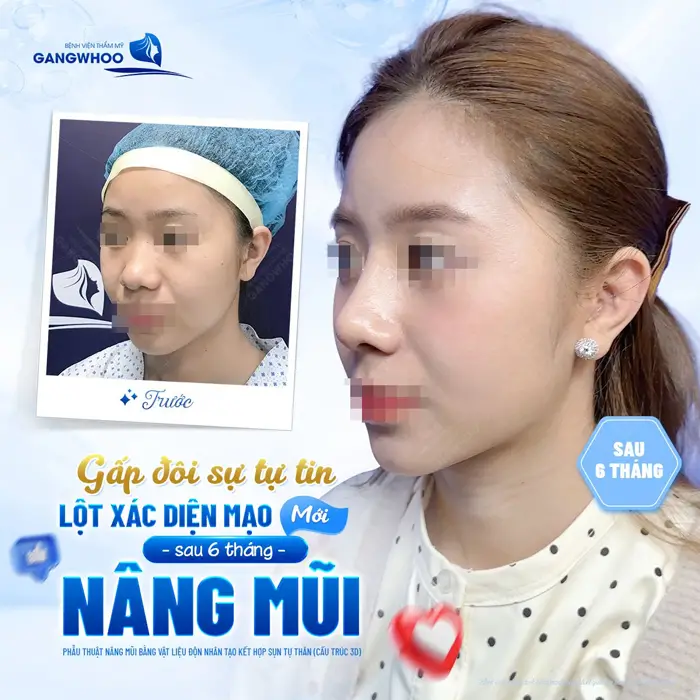 Gấp đôi sự tự tin lột xác diện mạo mới chỉ sau 6 tháng nâng mũi nhan sắc đã thăng hạng thấy rõ