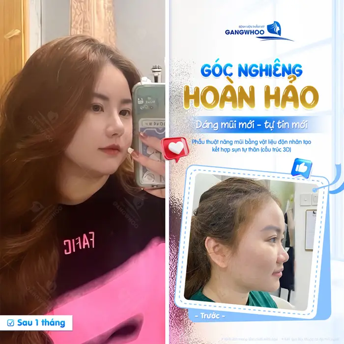 Góc nghiêng hoàn hảo dáng mũi mới tự tin mới sau 1 tháng nhan sắc và diện mạo đã đẹp chấn động 