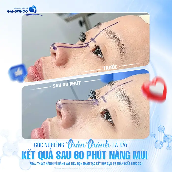 Nâng Mũi Bọc Sụn Được Bao Lâu? Cách Chăm Sóc Duy Trì Lâu Dài 1 Góc nghiêng thần thánh là đây kết quả sau 60 phút nâng mũi thay đổi diện mạo đến bất ngờ và đầy khó tin