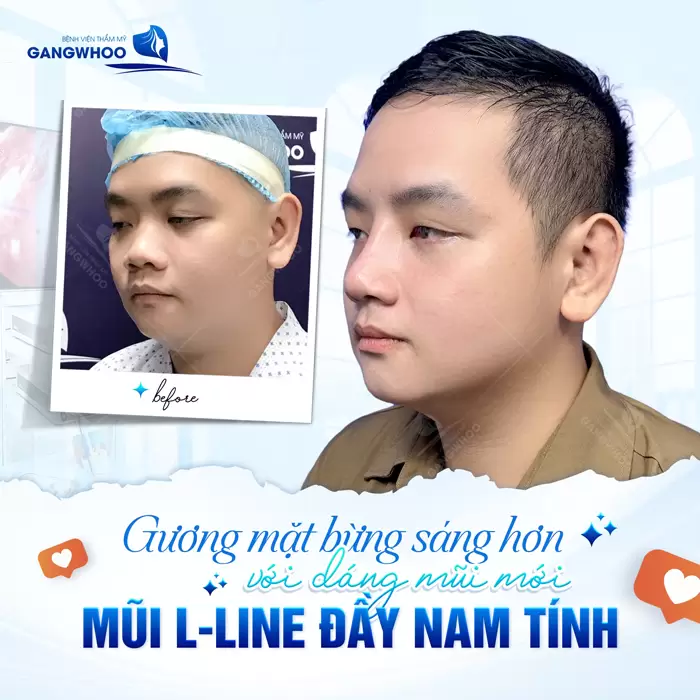Nâng Mũi L Line Là Gì? Phù Hợp Với Những Khuôn Mặt Nào? 3 Gương mặt bừng sáng đẹp chuẩn đầy nam tính sau khi thực hiện nâng mũi L Line