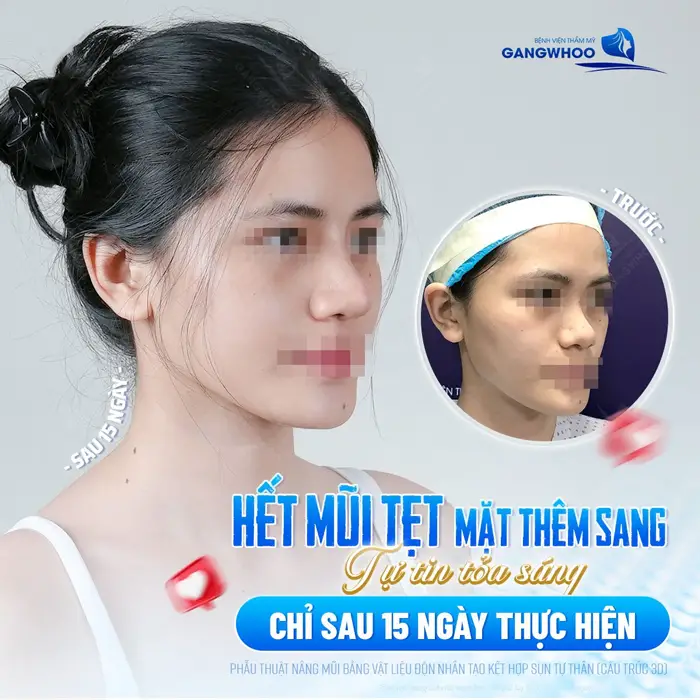 Hết mũi tẹt mặt thêm sang tự tin tỏa sáng chỉ sau 15 ngày thực hiện 