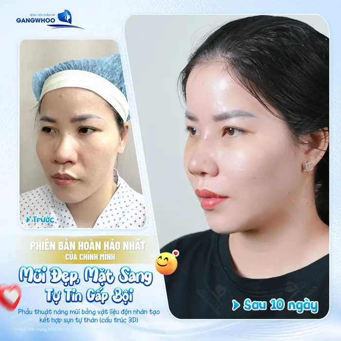 Mũi đẹp mặt sang tự tin gấp bôi sau 10 ngày nhan sắc đã thăng hạng lên 1 tầm cao mới