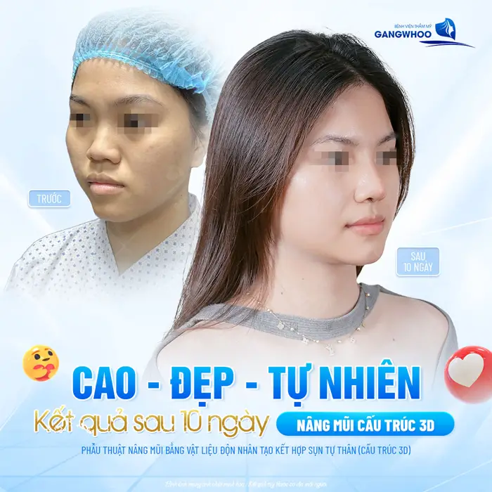 Kết quả sau 10 ngày nâng mũi đã cao đẹp và tự nhiên thấy rõ