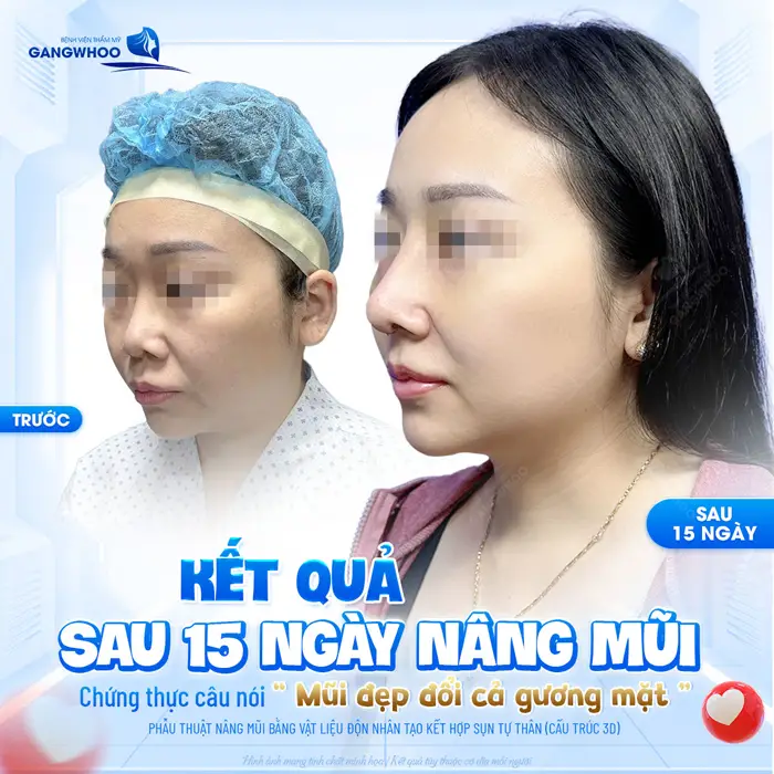 Kết quả sau 15 ngày nâng mũi thần sắc và diện mạo thăng hạng đẹp rõ rệt và chuẩn mềm mại