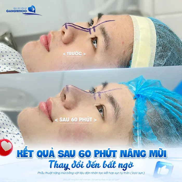 Kết quả sua 60 phút phẫu thuật nâng mũi thay đổi đến bất ngờ đẹp xuất sắc thấy rõ