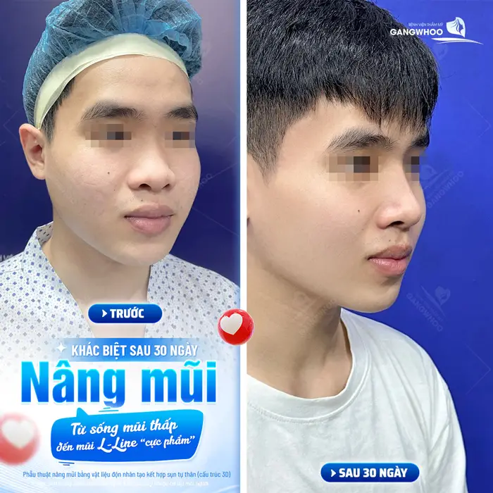 Nâng mũi nam sự khác biệt sau 30 ngày từ dáng mũi thấp đến dáng mũi cao đẹp cực phẩm 