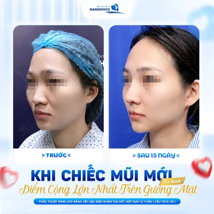 Khi chiếc mũi mới điểm cộng lớn nhất trên gương mặt cho diện mạo thêm hài  hòa và cuốn hút