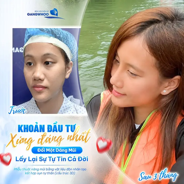 Nâng Mũi Bọc Sụn Hàn Quốc - Bí Quyết Dáng Mũi Cao Thanh Tú 1 Nâng mũi khoản đầu tư xứng đáng lấy lại sự tự tin cho diện mạo xinh đẹp cả đời